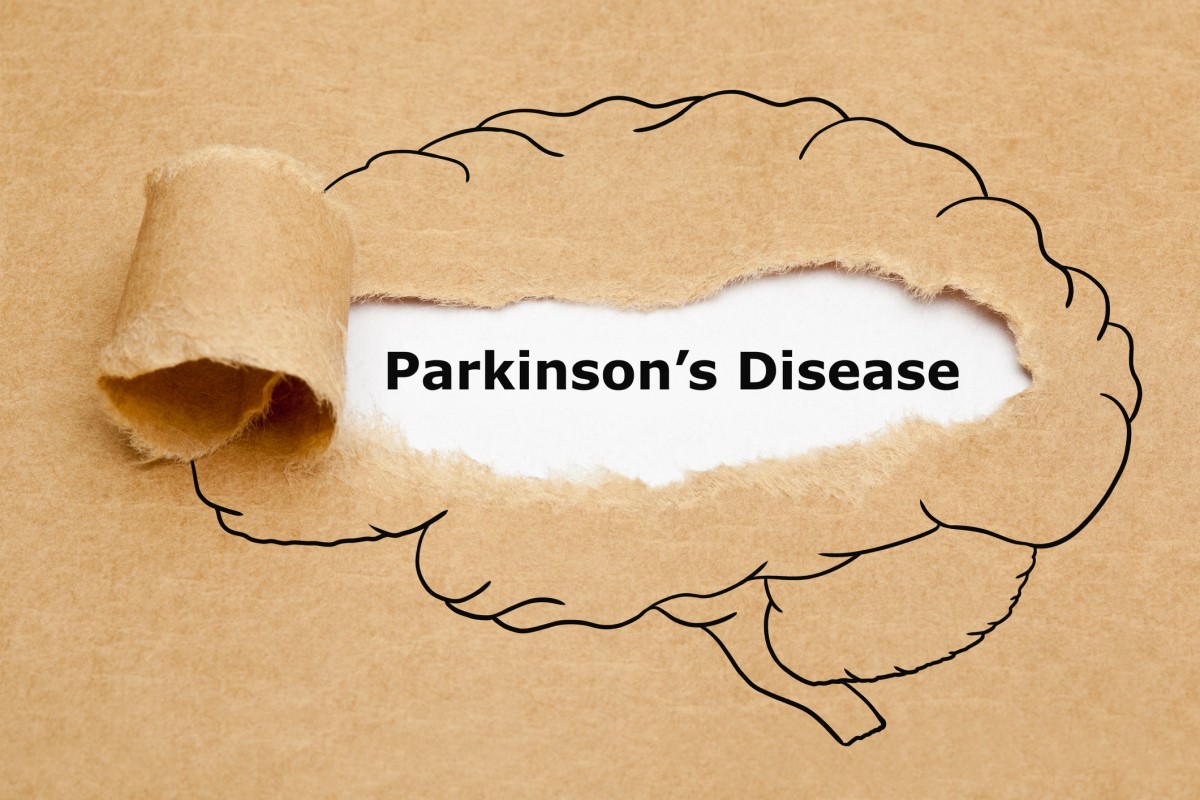 Morbus parkinson = Parkinsons disease = Enfermedad de Parkinson - animación de un cerebro con la enfermedad de Parkinson en el centro