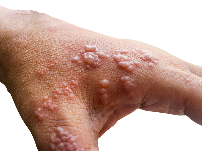 Herpes en la mano