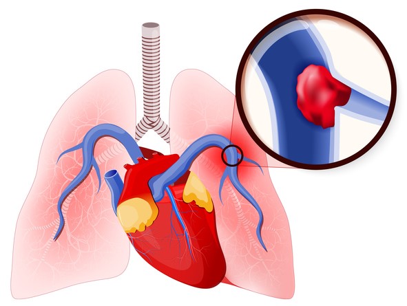 Embolia pulmonar, cierre de la arteria pulmonar por un coágulo sanguíneo.