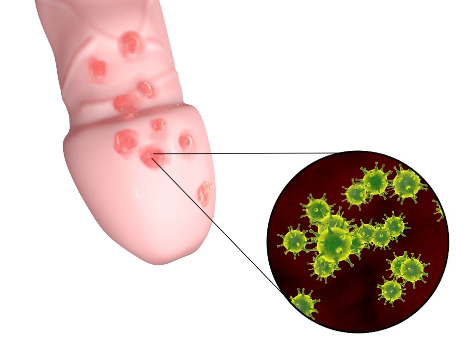 Formación de pequeñas ampollas de herpes genital en la zona genital del órgano masculino.