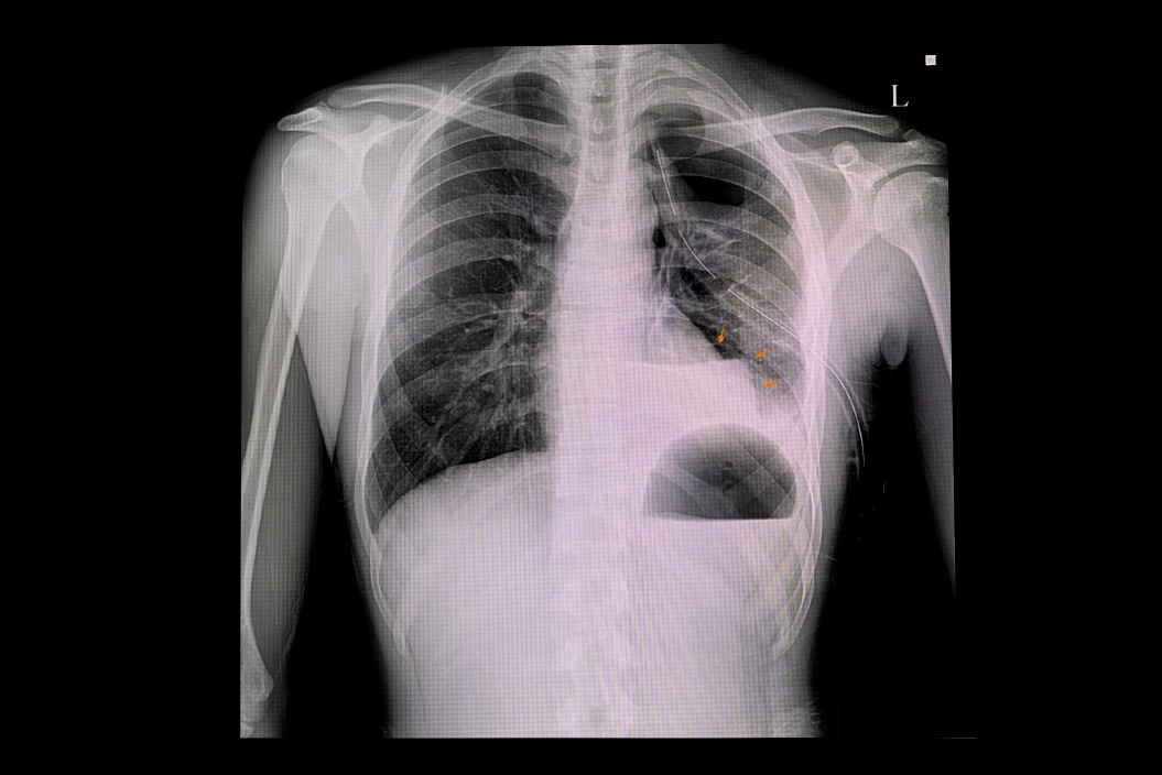 Radiografía de neumotórax del pulmón izquierdo y acumulación de aire en la cavidad pleural del tórax (color blanco).