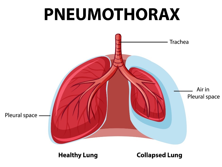 Neumotórax: pulmones sanos y colapsados