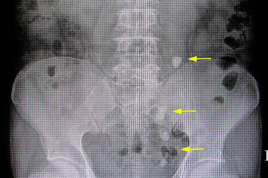 Radiografía: numerosos concreciones en el curso de las vías urinarias