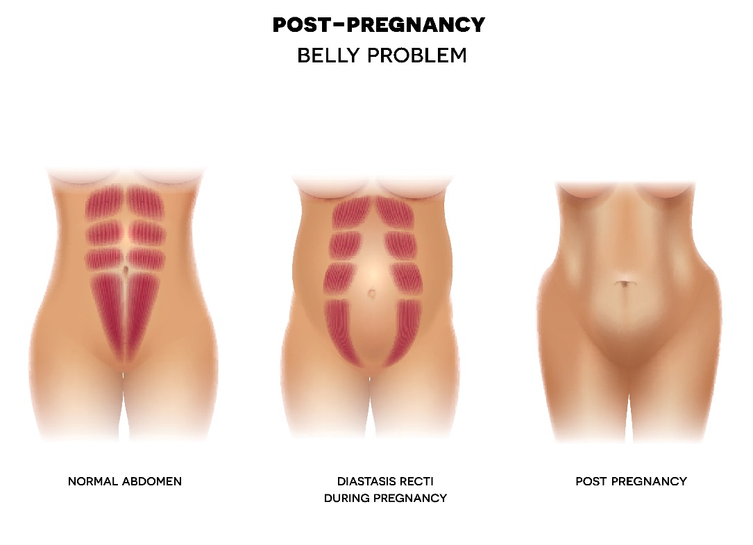 Diástasis postparto de la pared abdominal