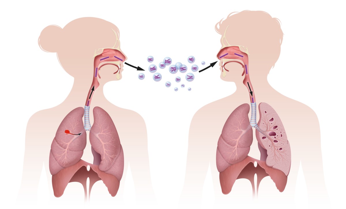 En la figura se muestra la transmisión de la tuberculosis por inhalación.