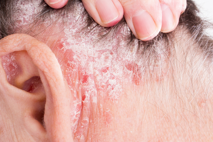 Psoriasis en la cabeza, detrás de la oreja y en el pelo de la cabeza