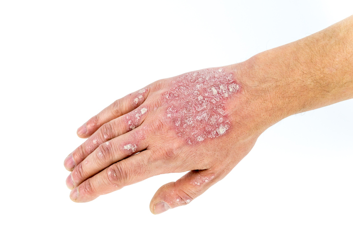 Psoriasis o psoriasis en la mano, dorso de la mano