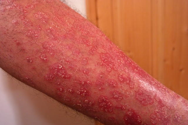 Psoriasis en la extremidad superior, en el antebrazo