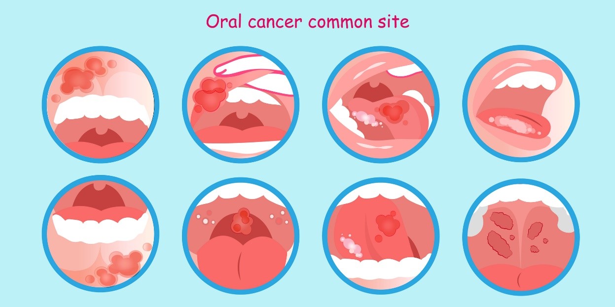 Cáncer oral y depósitos tumorales: un modelo