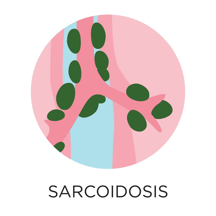 Sarcoidosis - formación de granulomas