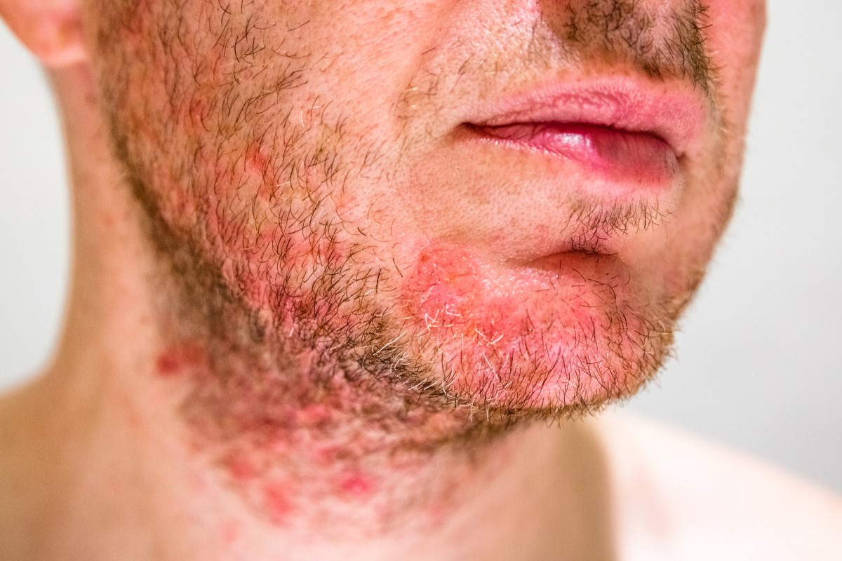 Hombre con seborrea en la barbilla, cara roja con signos de dermatitis