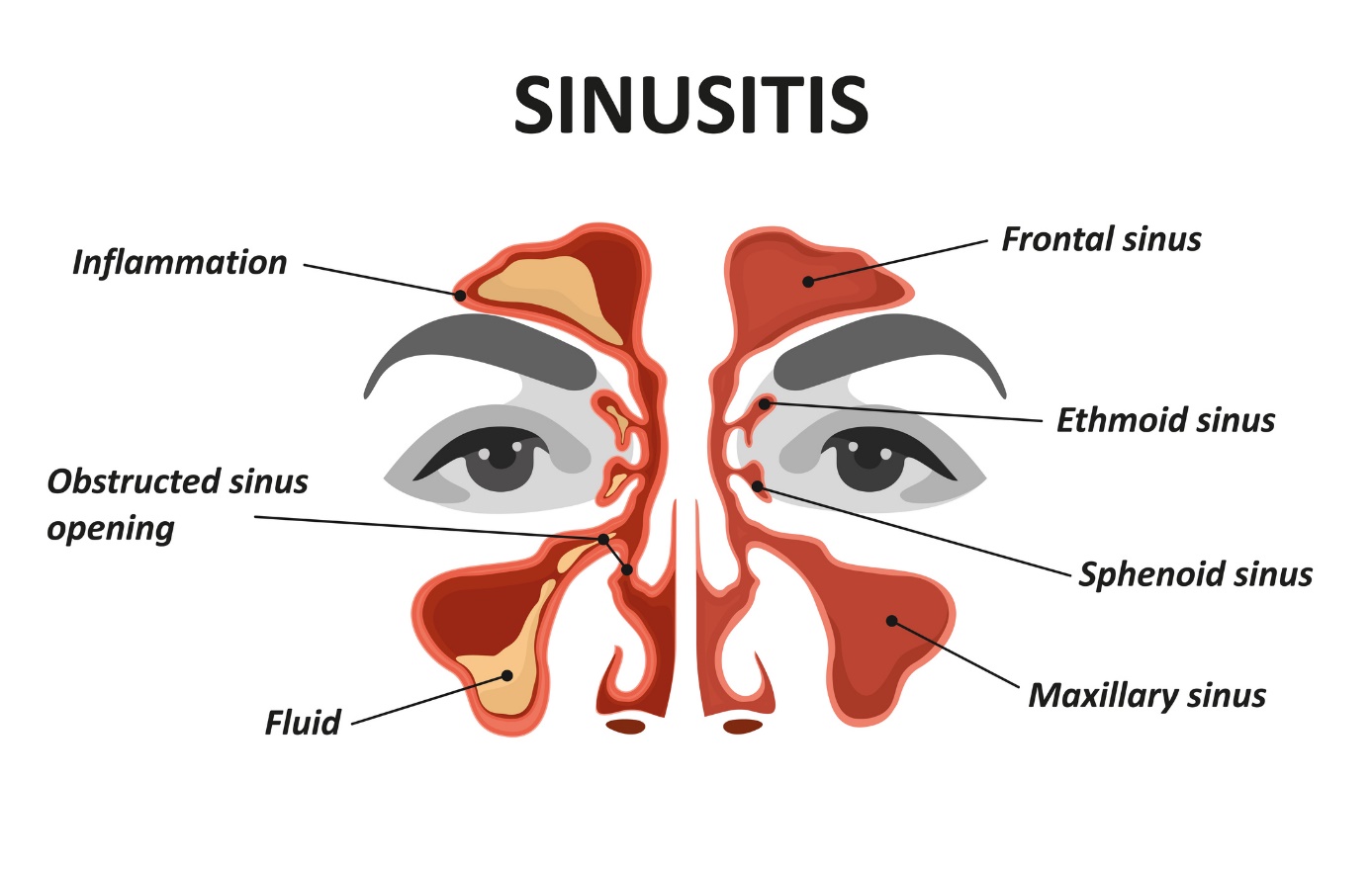 Modelo animado/imagen de sinusitis y sinusitis