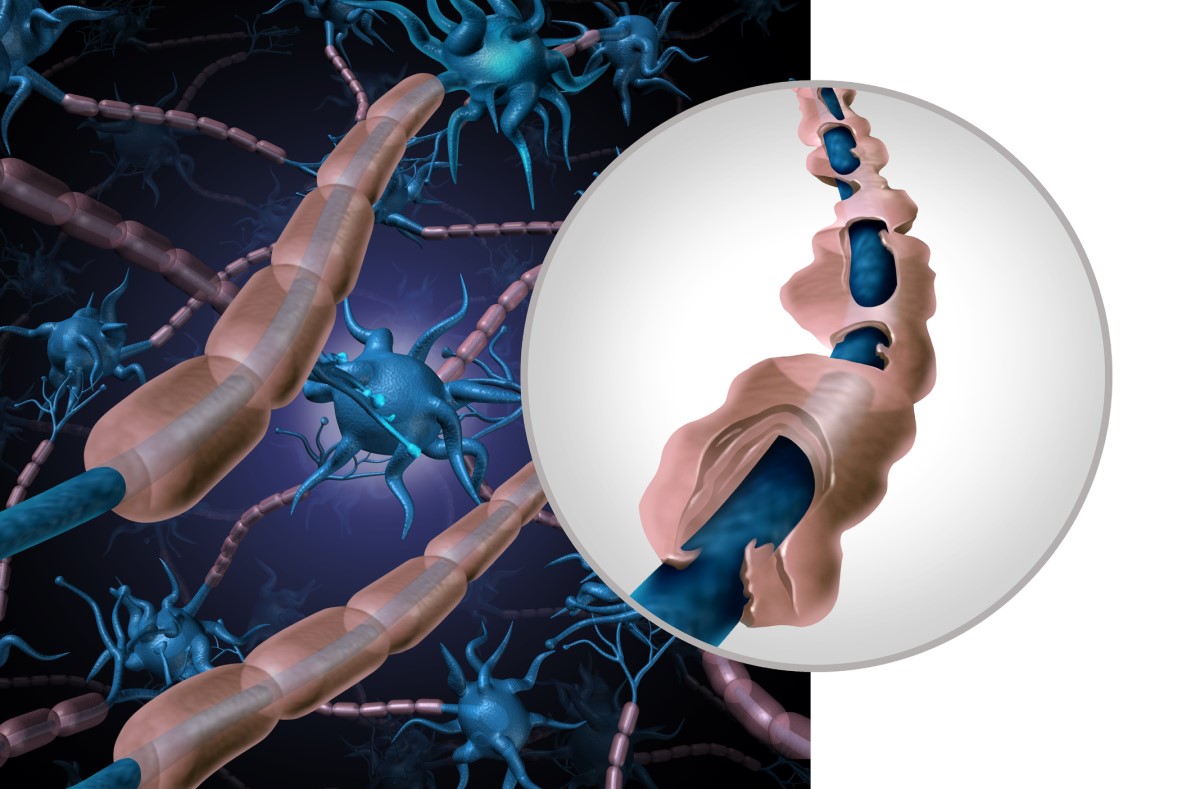 Representación anatómica y pictórica de la neurona sana y dañada - fibra desmielinizada