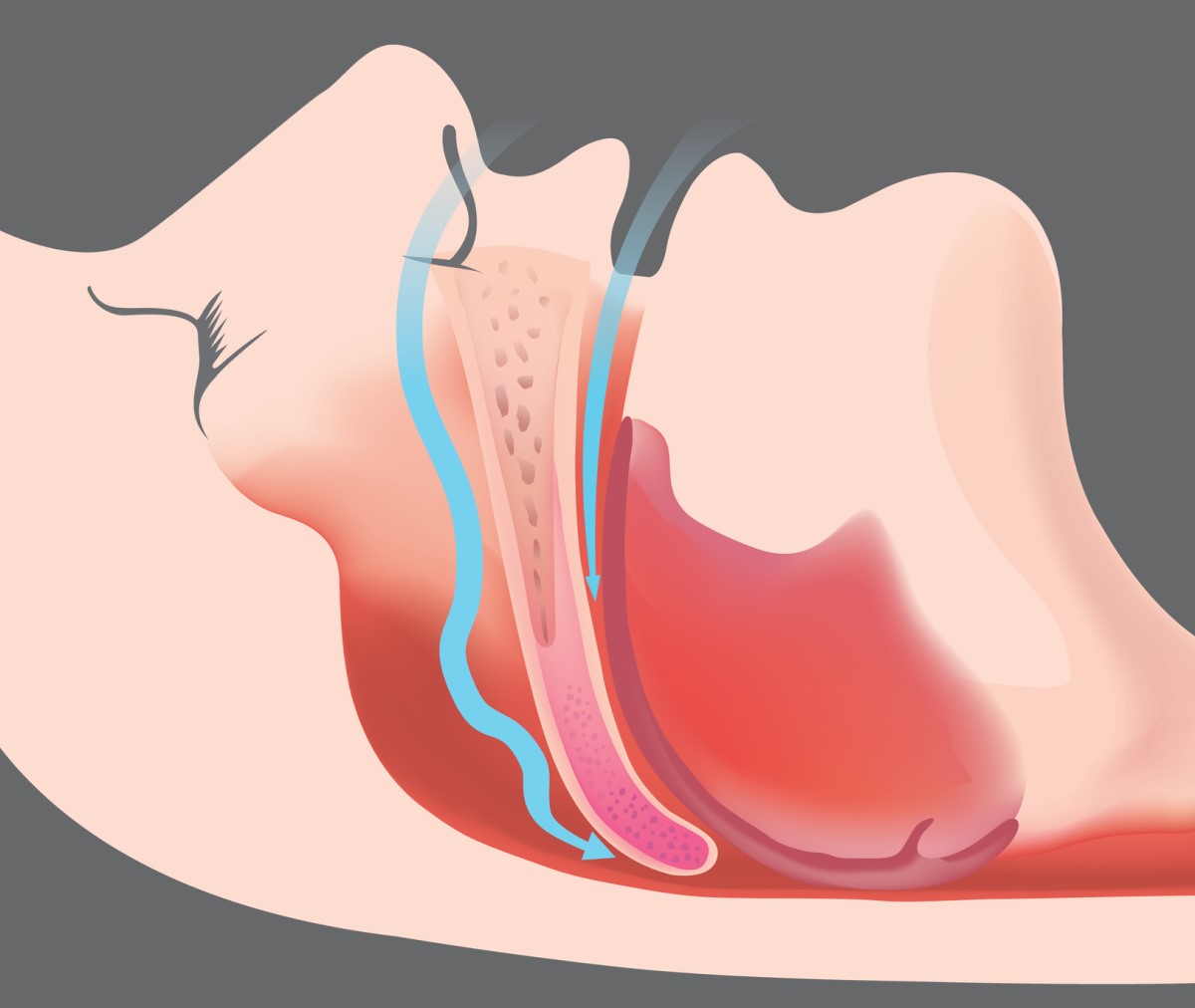 Apnea obstructiva y obstrucción de las vías respiratorias - imagen animada y modelo de vías respiratorias