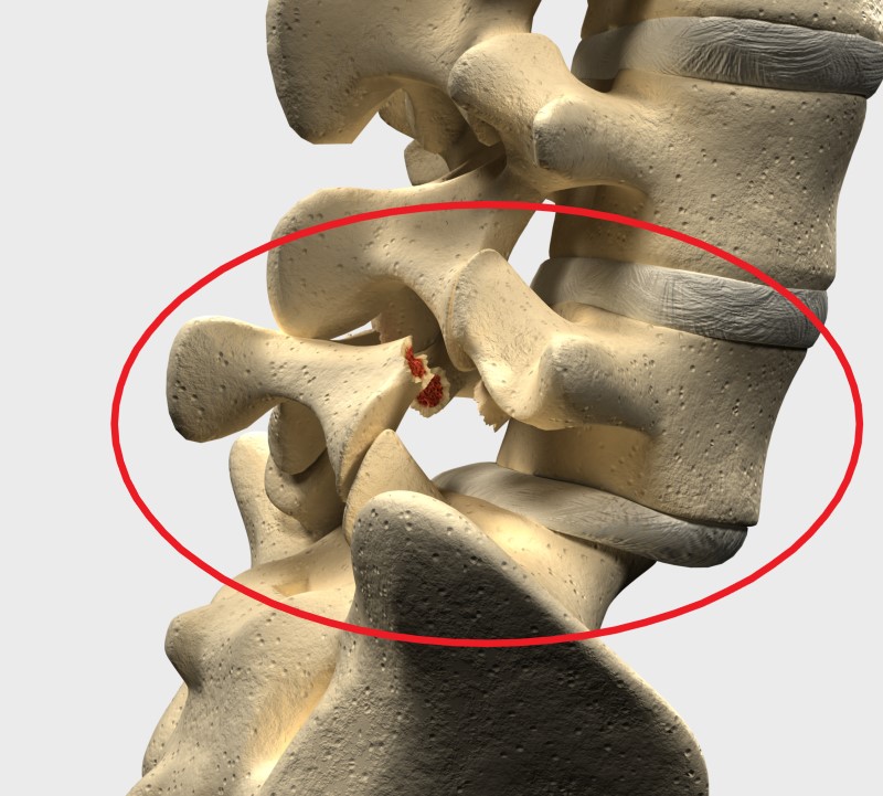 Espondilolistesis en la región lumbar L5 y S1 - modelo de esqueleto vertebral