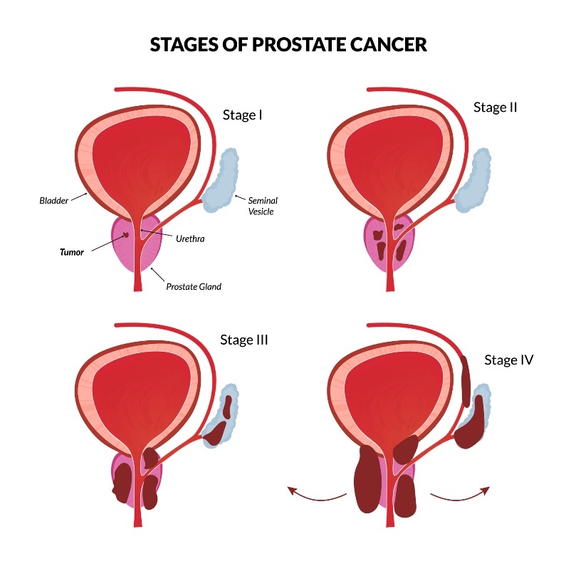 4 estadios básicos del cáncer de próstata