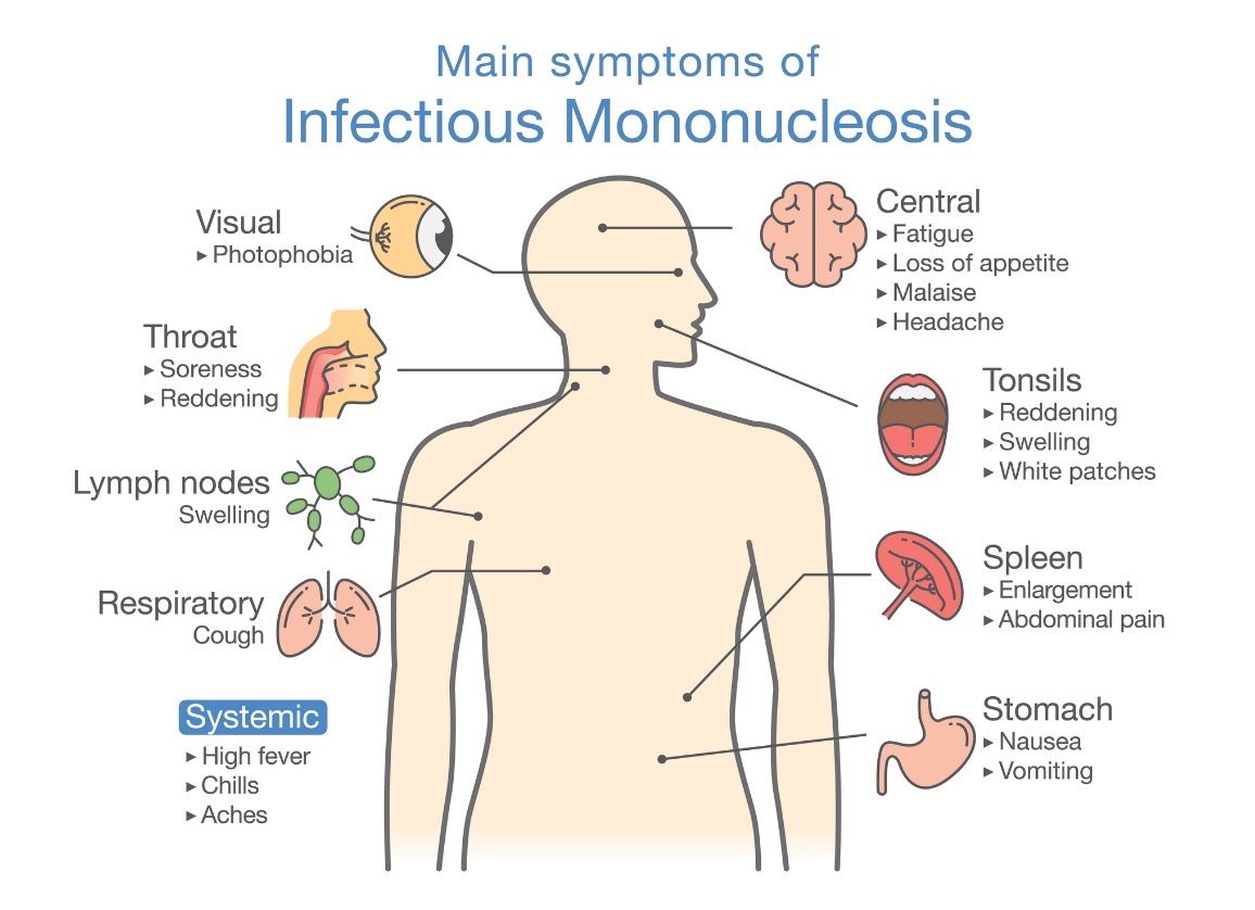 Síntomas de la mononucleosis infecciosa