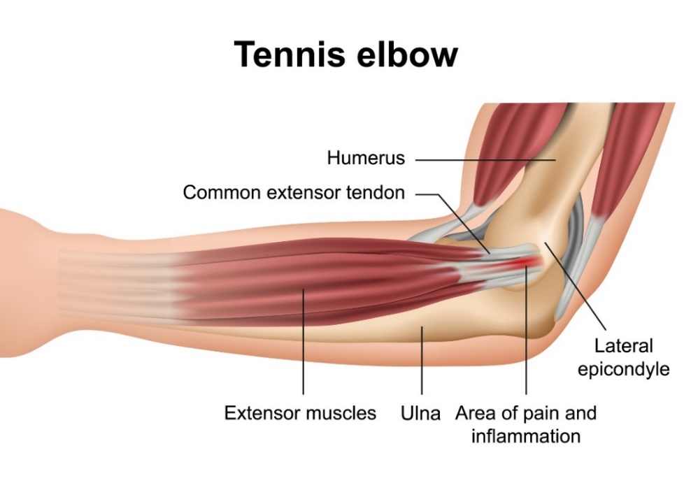 Codo de tenista (epicondilitis lateral): los huesos de la articulación del codo, los extensores de los músculos del antebrazo, el epicóndilo lateral y el lugar del dolor primario.