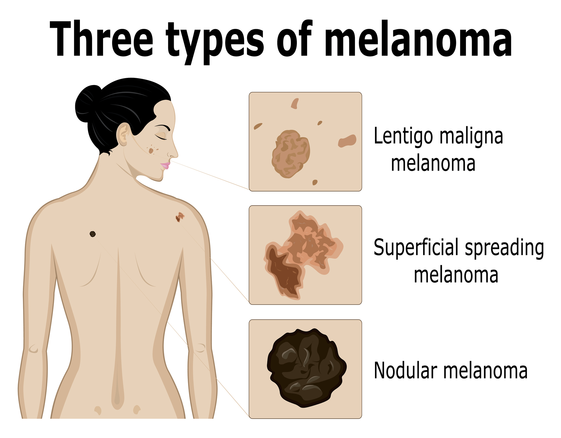 Imagen de los tres tipos de melanoma