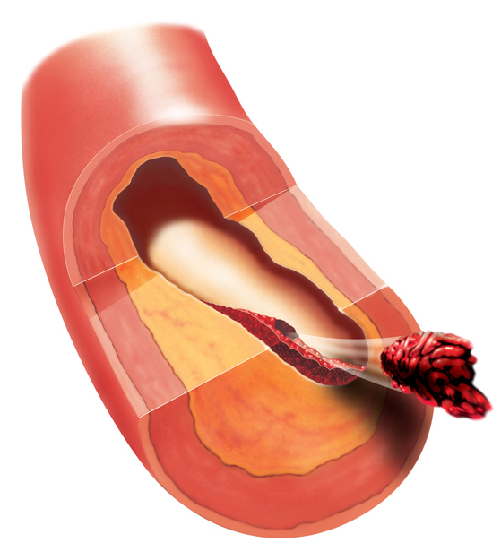 Trombosis en un vaso sanguíneo, desprendimiento de un trombo, émbolo, embolia por un coágulo sanguíneo