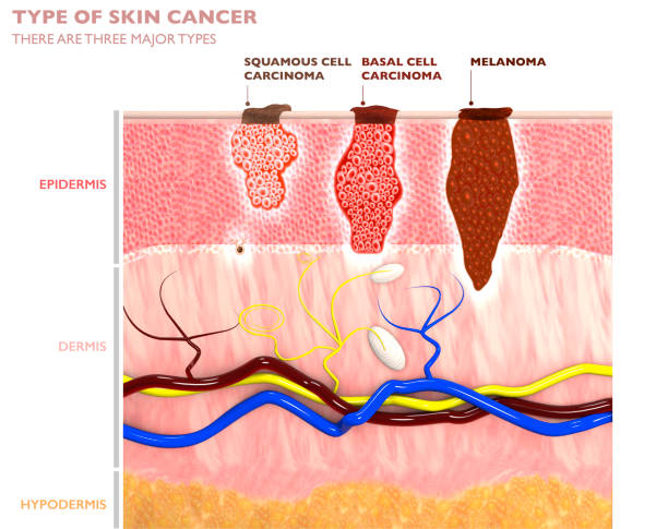 Tipos de tumores cutáneos, su penetración en la piel: carcinoma de células escamosas, basalioma y melanoma.