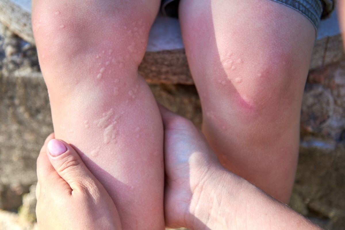 Urticaria en un niño en los miembros inferiores