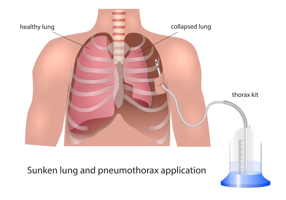 Visualización del drenaje pleural en el neumotórax: pulmón sano, pulmón colapsado y dispositivo de drenaje.