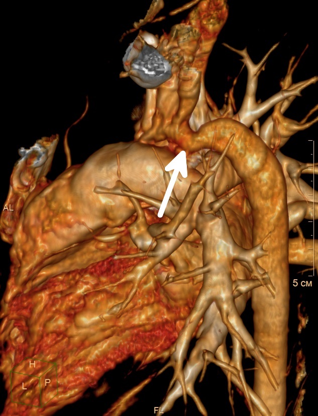 Visualización de la coartación (estrechamiento) de la aorta en la parte descendente del vaso cardíaco.