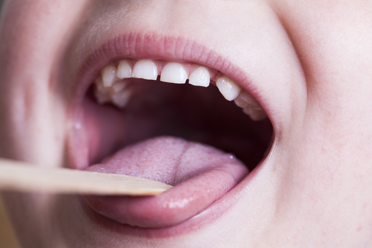 Examen de la garganta con un palillo bucal de madera - niño