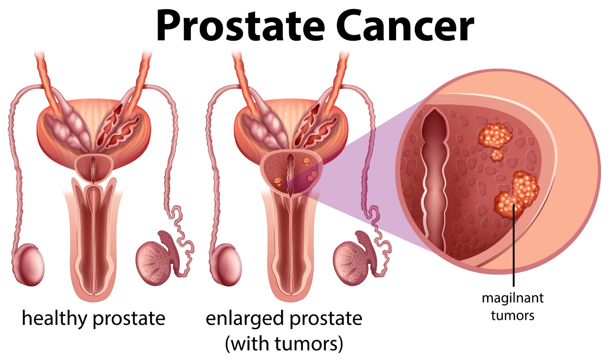 Cáncer de próstata. Próstata sana y próstata agrandada con tumor