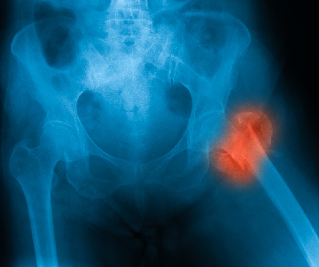 Fractura del cuello femoral