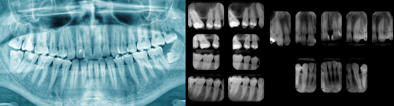 Radiografía dental para mostrar el estado de los dientes, caries y empastes