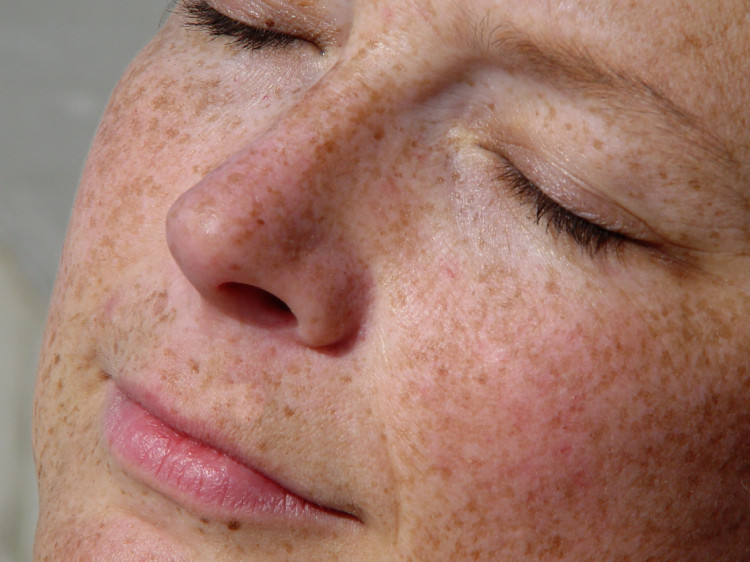 un rostro femenino satisfecho con manchas pigmentarias y ojos cerrados