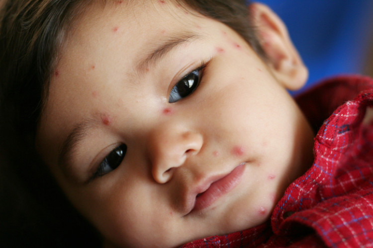 niño con camisa roja y varicela