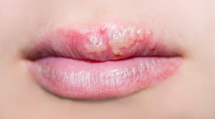 herpes en el labio superior