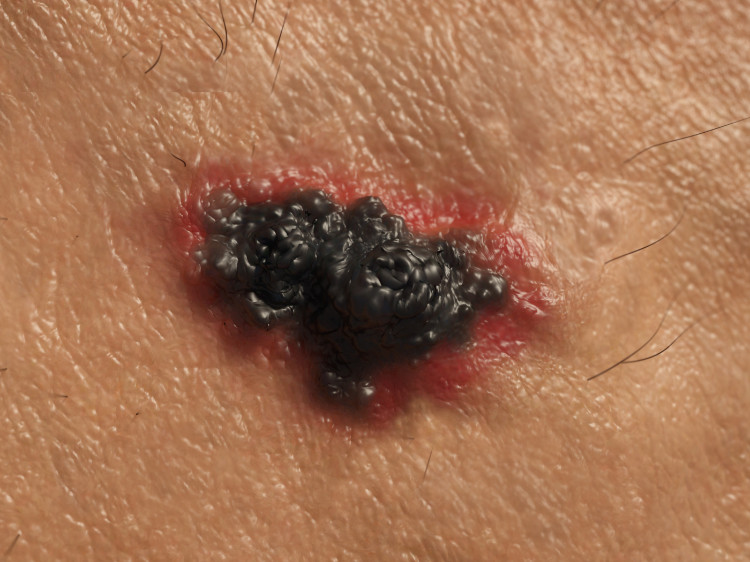 cáncer de piel, melanoma negro maligno con bordes rojos