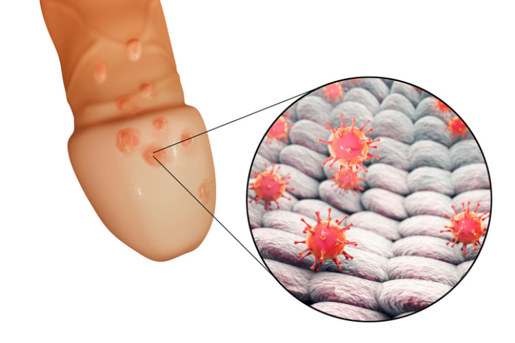 herpes genital en el pene y virus del herpes a nivel microscópico