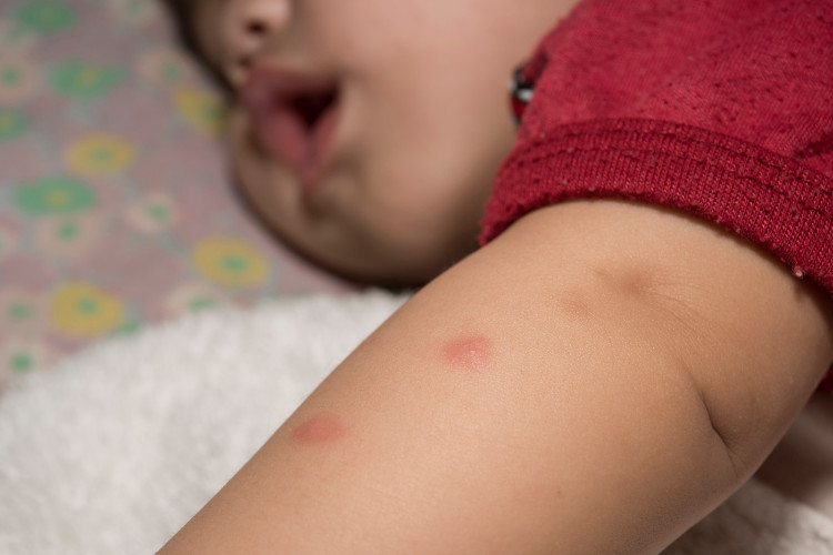 un niño con una camiseta roja y una picadura de mosquito en el brazo