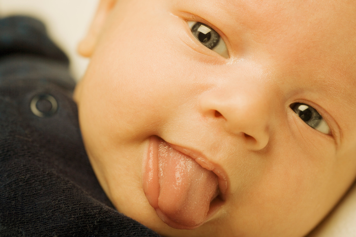 niño con ictericia lengua rastrera