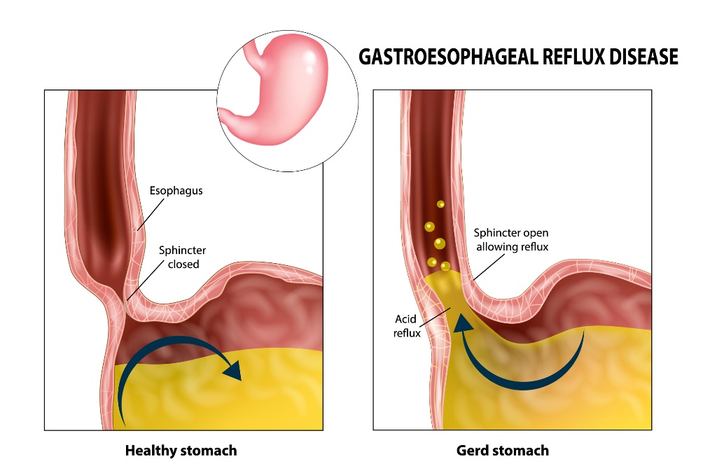 Reflujo gastroesofágico: esófago, esfínter, estómago y ácido gástrico