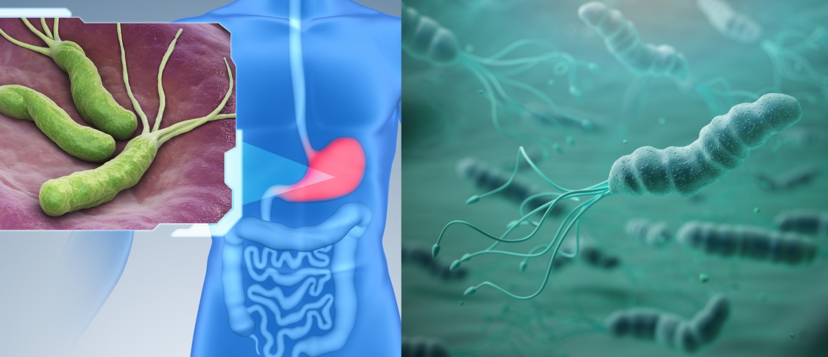 El Helicobacter pylori coloniza la mucosa del estómago y es un factor de riesgo de gastritis, úlcera y cáncer.