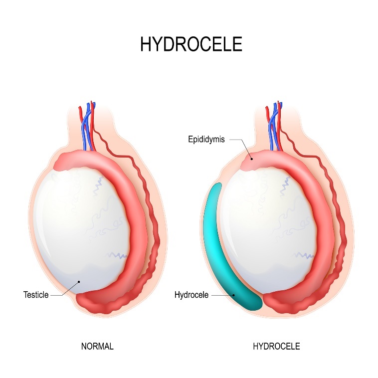 Hidrocele: testículo, epidídimo, Hidrocele (líquido acumulado)