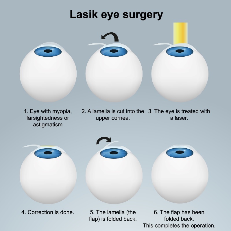 Cirugía ocular con láser LASIK - método subsuperficial. Procedimiento con colgajo/solapa sin dañar las terminaciones nerviosas.