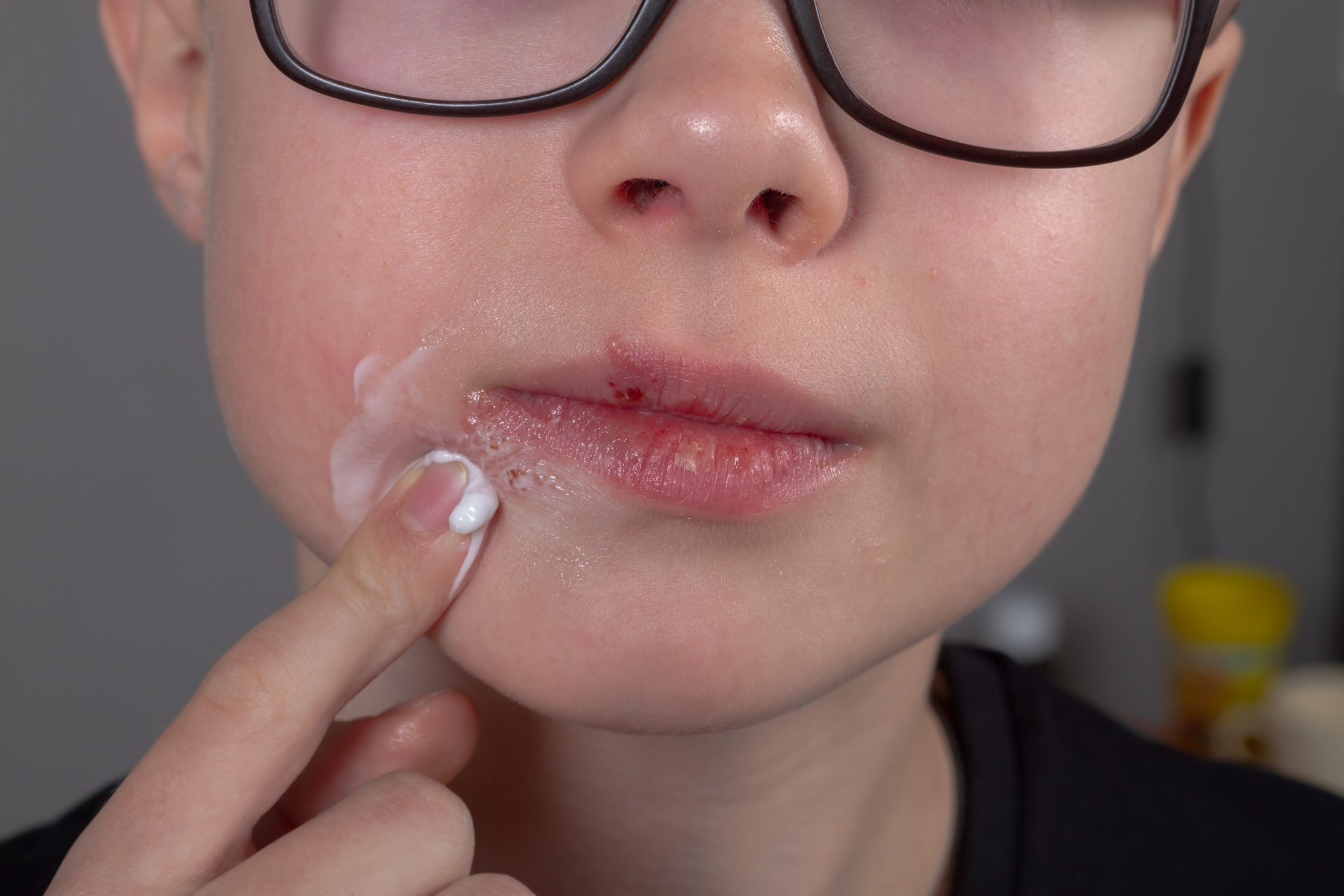 cómo tratar las comisuras de los labios