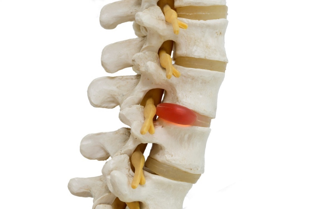 Representación anatómica de un modelo 3D de la columna vertebral, discos intervertebrales y hernia discal con compresión nerviosa.