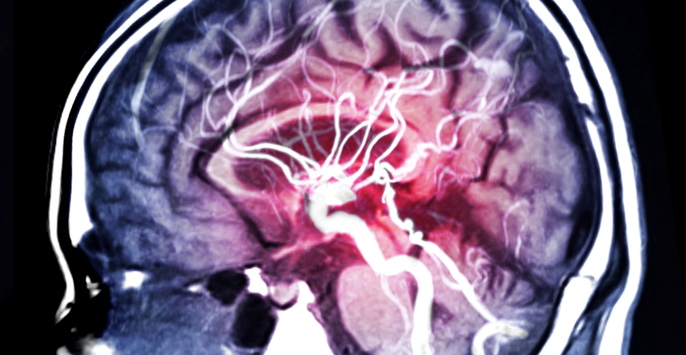 ARM: examen por RM de los vasos cerebrales