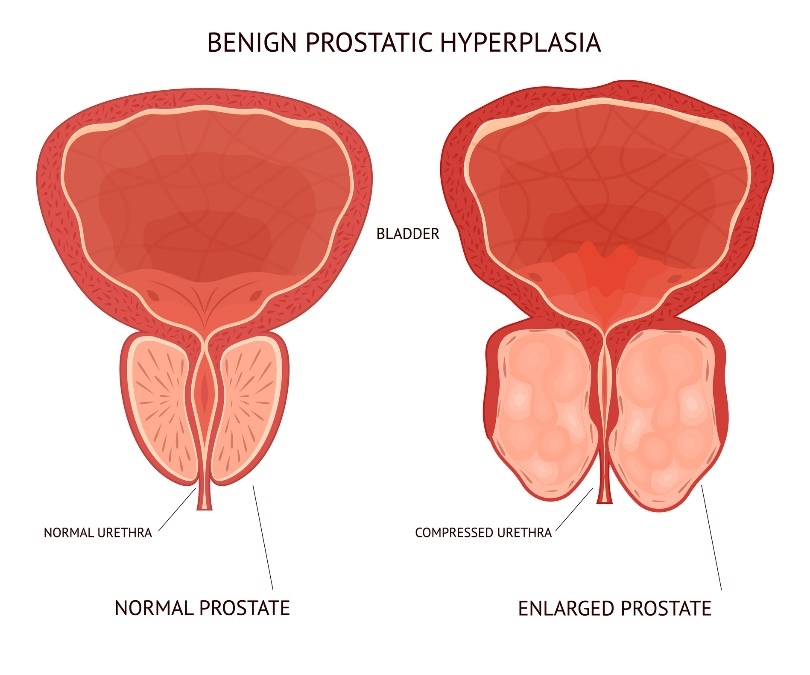 Agrandamiento benigno de la próstata. Vejiga (bladder), tejido fisiológico y agrandado del órgano prostático.