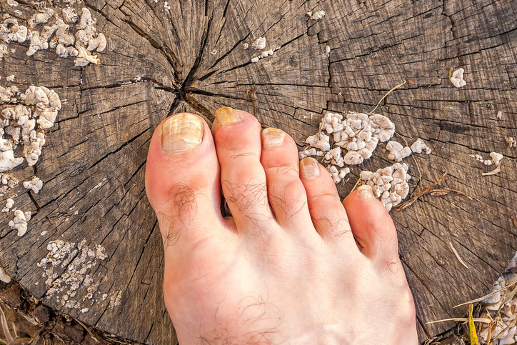 un pie con hongos en las uñas, tumbado sobre un tocón de árbol