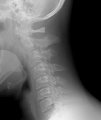 Radiografía de la columna cervical