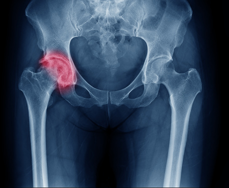 Radiografía de la pelvis, articulación de la cadera derecha afectada por artrosis.